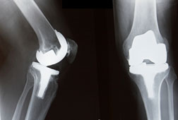 Hawaii DePuy Knee Lawsuits