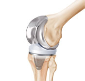 DePuy Knee Problems