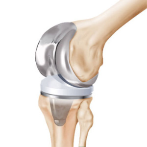 DePuy Knee Revision Surgery