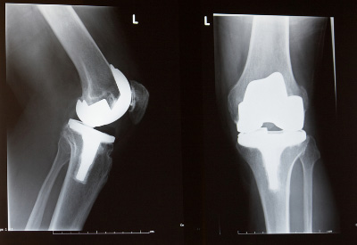 DePuy Knee Recalls